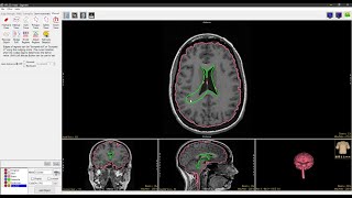 Analyze 15.0 - Segment Nudge Edit