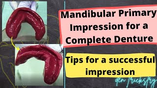 Mandibular Primary Impression for an Edentulous Patient (Complete Denture Impression)