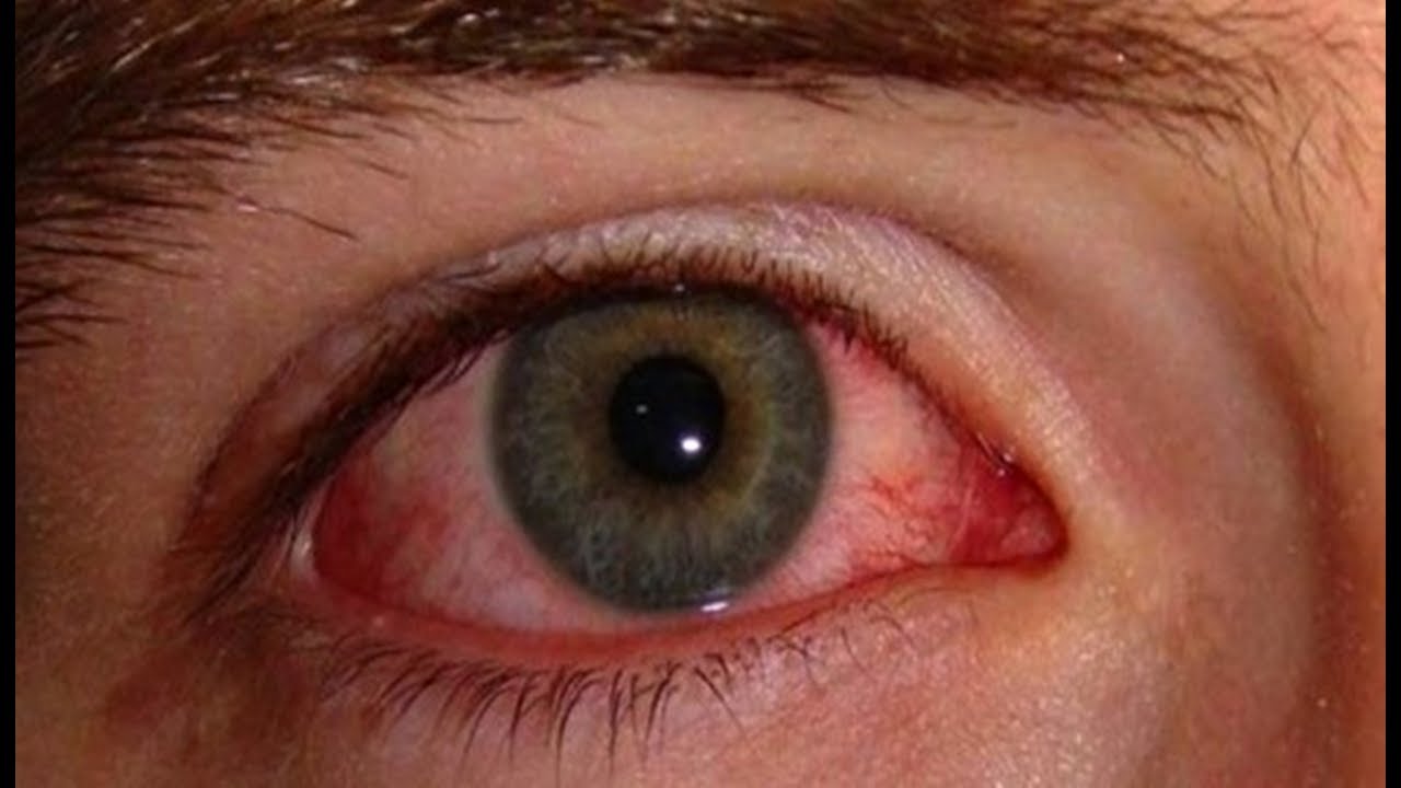 Porque Quando Choramos Os Olhos Ficam Vermelhos