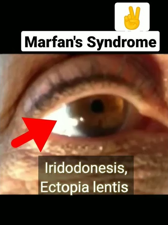 Marfan's Syndrome- Ectopia Lentis