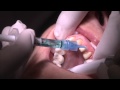 Veneer Replacement Procedure