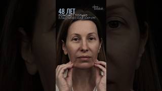 Фейслифтинг. Лобно-височный лифтинг. Низ блефаро. Доктор БАДАК