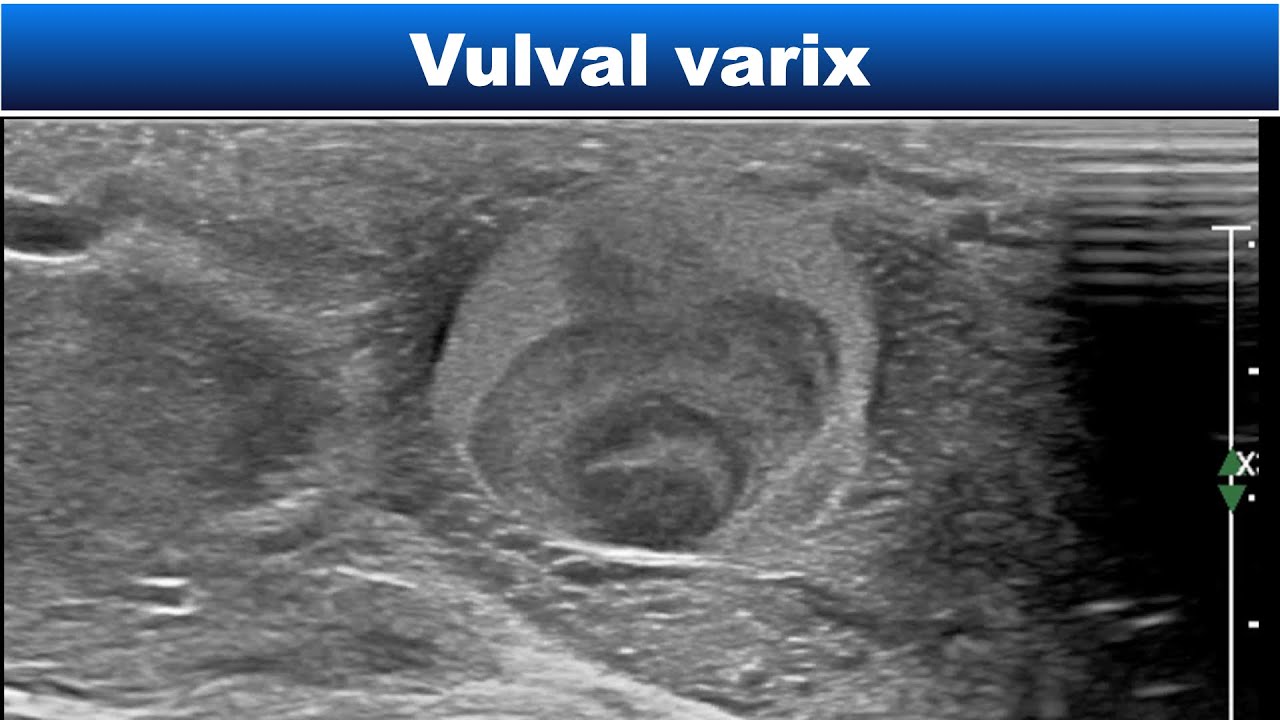 Vulvar varix