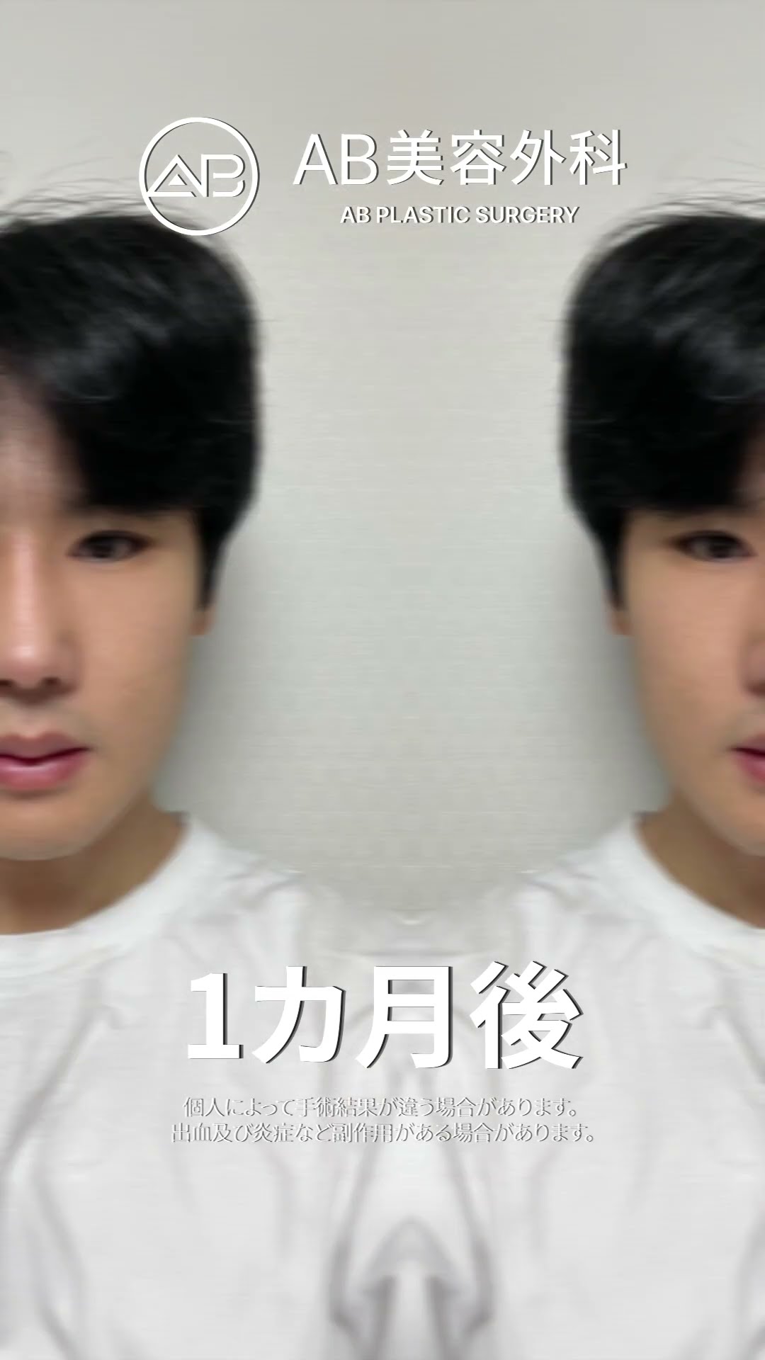 整形が彼の人生を変えた – ビフォーを見ると驚くはず！ #韓国整形 #美容
