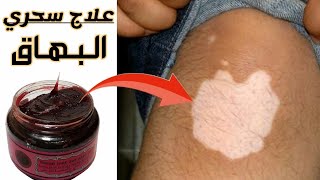 علاج البهاق بالصابون المغربي ( وصفة مضمونة )