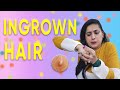 Ingrown Hairs? How to get rid of them in Easy Simple Steps 😉😉 Ingrown Hair Removal Remedy