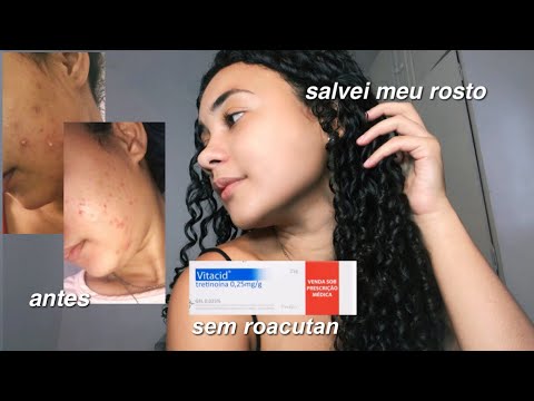 COMO ACABEI COM MINHAS ESPINHAS | sem tomar roacutan