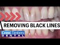 Case of the Week - Removing black lines