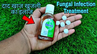 फ़ंगस इनफ़ेक्शन दिनाय, दाद, खाज का इलाज   Treating Fungal Infection In HINDI Full HD