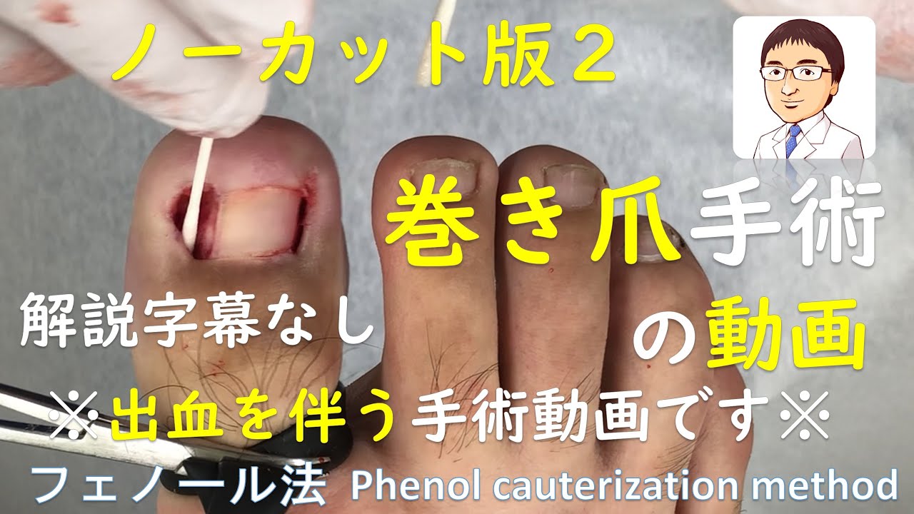 巻き爪の手術動画 ノーカット Ver 2 です 解説字幕なし 医療関係者向け参考動画 Ingrown Toenails Phenol Cauterization Method Uncut Video2 Youtube
