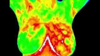 THERMOGRAPHY: BREAST CANCER DETECTION YEARS BEFORE MAMMOGRAPHY