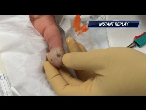 finger pulp abscess drainage EXPLOSION of pus - watch to the end for patient POEM