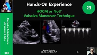 Hands-On Experience 23: HOCM or Not? Valsalva Maneuver Technique