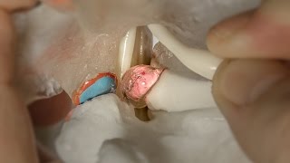 Intervertebral Disc Model - DDD model