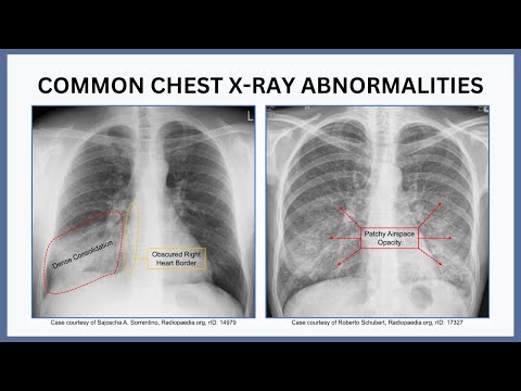 Common Chest X