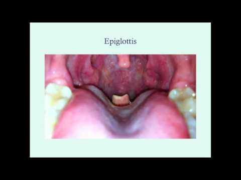 Epiglottitis - CRASH! Medical Review Series