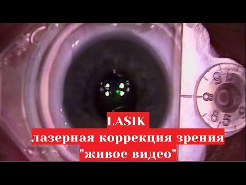 ЛАСИК  - "живое" видео 😲 операции лазерной коррекции зрения по методу LASIK в Москве