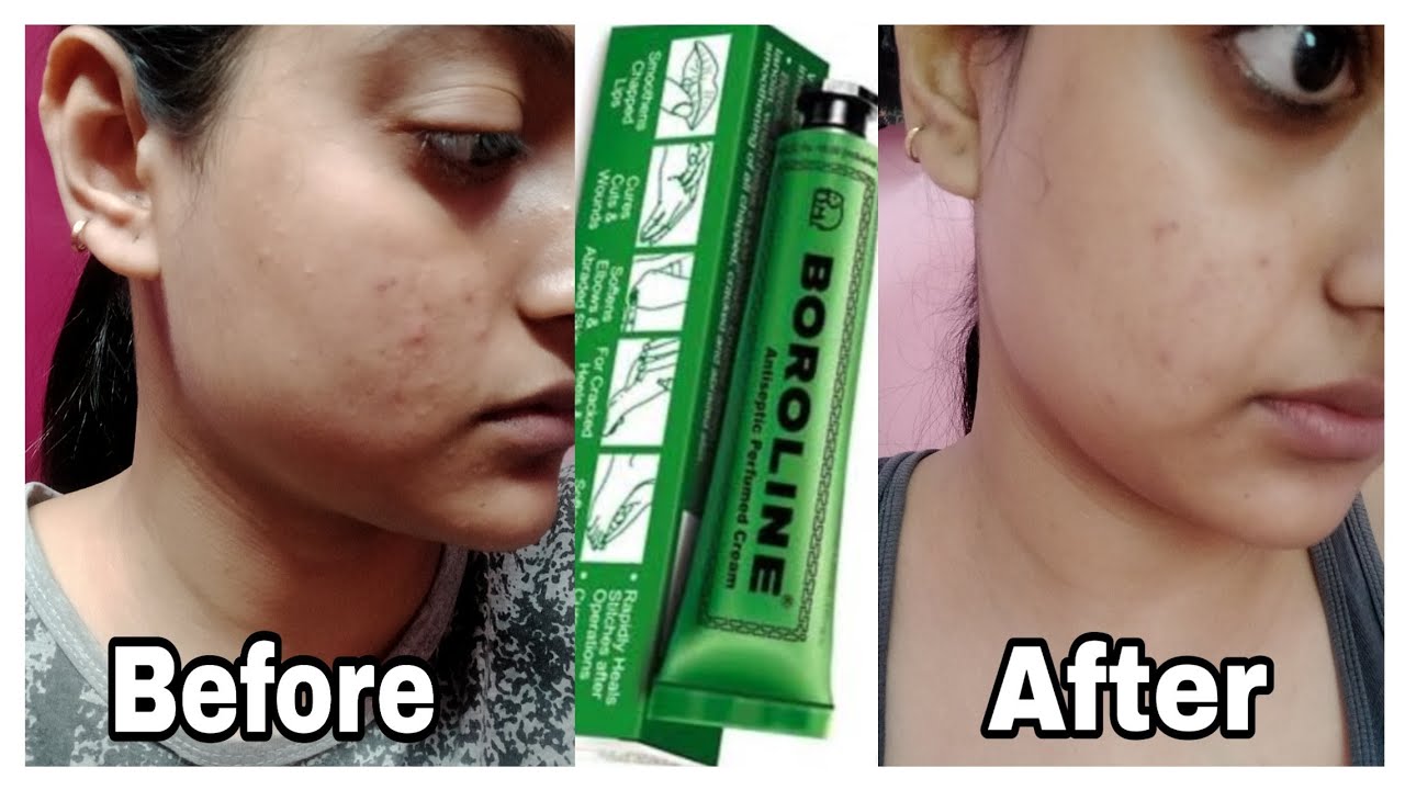boroline for acne