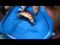 Эстетическая реставрация зубов с применением компониров