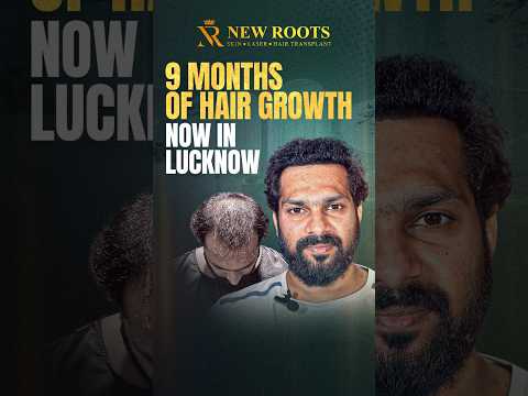 9 Months Hair Transplant Result in Lucknow #hairtransplant #lucknow #shorts