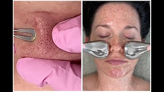 video thumbnail for: Brown Spot Lightening + Clogged Pores Exfoliating Facial {Meditation ASMR Massage}
