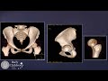 V. Upasani, 3D characterization of acetabular defieciency in DDH, Hip Symposium 2018