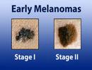 Treating Melanoma (Skin Cancer #8)