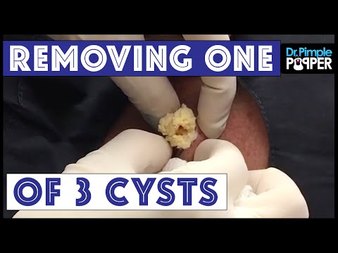 The Bermuda Triangle: Cyst Excision #1