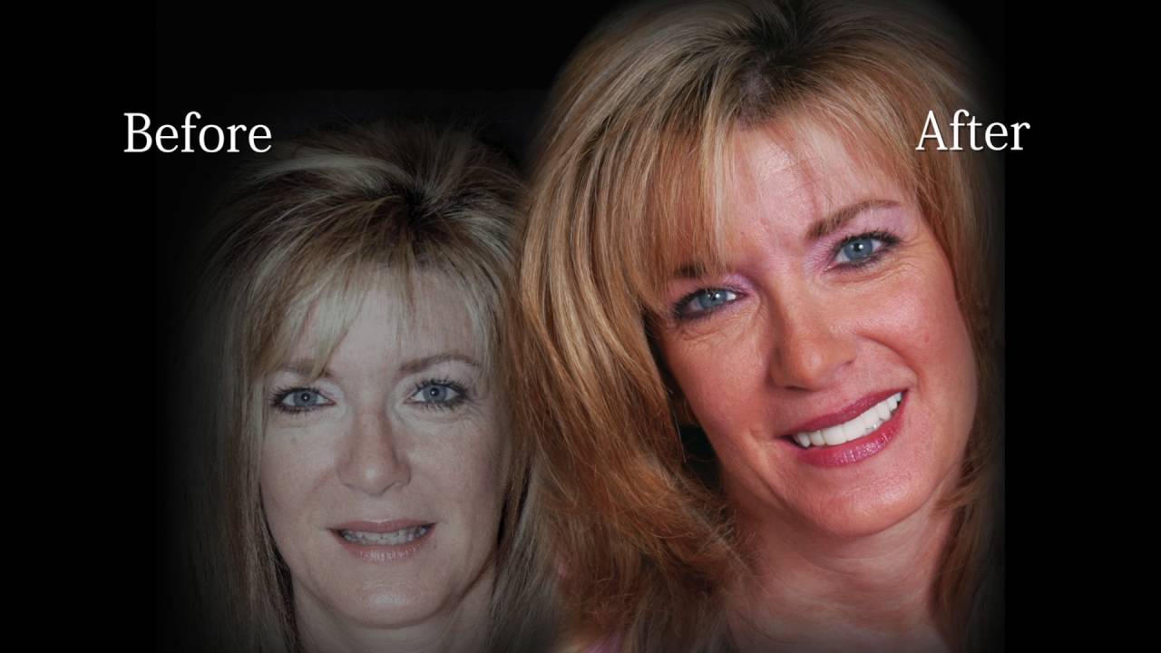 smile lift at willow bend dental youtube willow bend dental