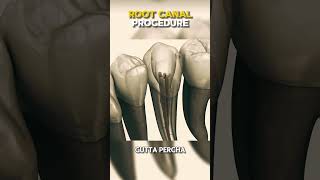 How ROOT CANAL Procedure is performed? #medical #4d