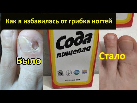 Как я избавилась от грибка ногтей. Самый дешевый способ без таблеток