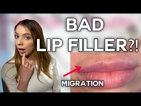 Does Filler Migrate? How Long Do Fillers Last? - YouTube