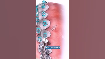 Quy trình gắn minivis khi niềng răng #niengrang #nhakhoahanoisydney #dentist #trend #nhakhoauytin
