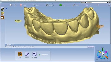 Contralateral Copy from Existing Dentition (Mirroring)
