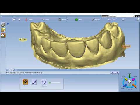 Contralateral Copy from Existing Dentition (Mirroring)