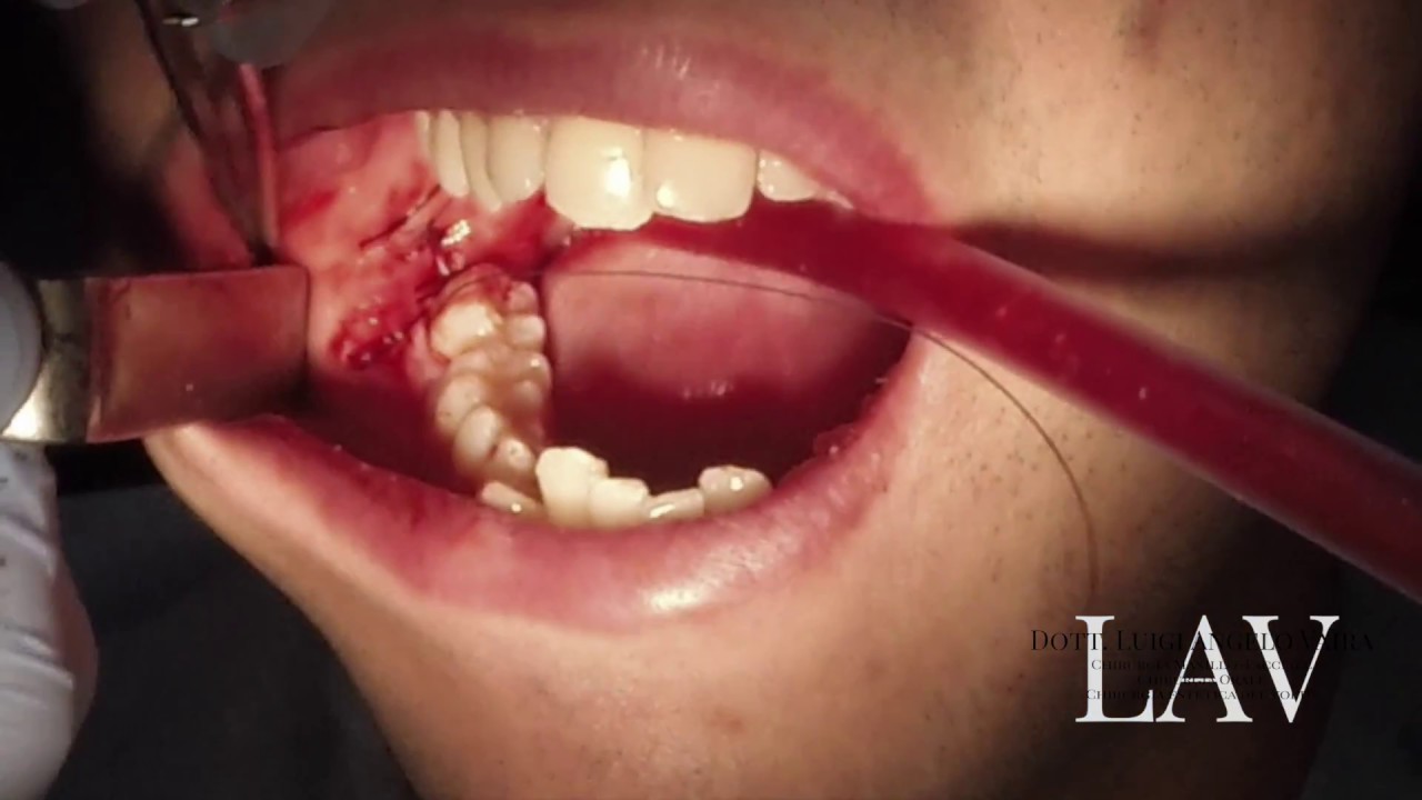 Chirurgia Maxillo Facciale Estrazione Dente Giudizio Estrazione chirurgica di dente del giudizio - Dott. Vaira Chirurgo