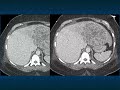 Ct evaluation of liver masses key differential diagnosis pathways  part 4