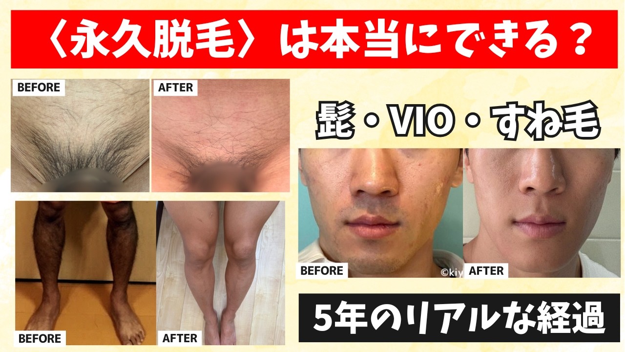 実体験】家庭用脱毛器で永久脱毛はできる？脱毛機マニアがセルフ脱毛を