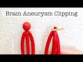 Playdough surgery   brain aneurysm clipping