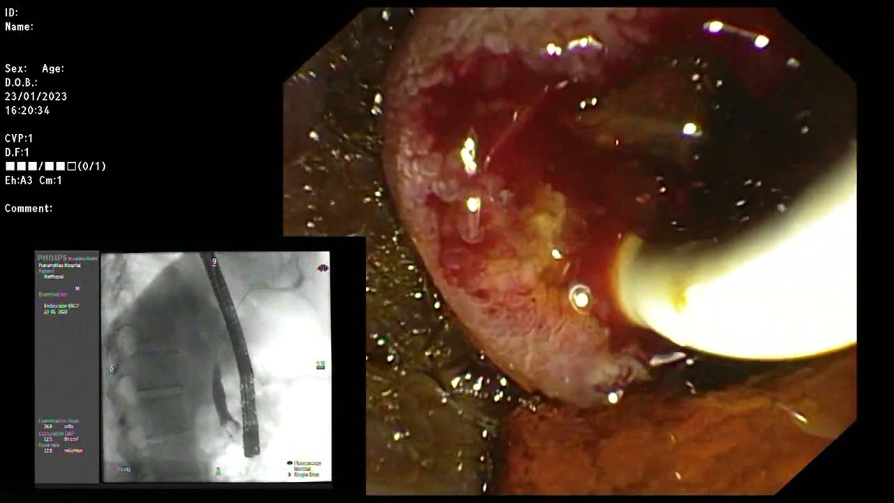 ERCP : Intradiverticular type ampulla, simple EST with CBD stones removal