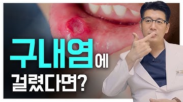 치과의사 추천!! 구내염에 걸렸다면 이렇게 해보세요