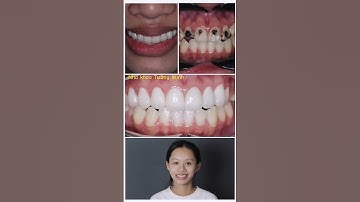 Tìm lại nụ cười tự tin cho bạn đẹp bằng răng sứ cao cấp #nhakhoatuongminh #veneers