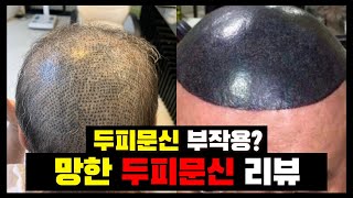두피문신 후회... 망한 두피문신 리뷰 &amp; 복구시술 결과