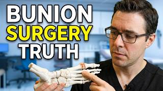 Bunion Surgery Bunionectomy vs Lapiplasty Which is Better