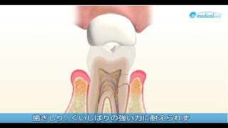 歯ぎしりのためのマウスピース治療