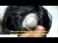 SEBACEOUS CYST ON HEAD HUGE Barbara A Lamm SEBACEOUS CYST ON HEAD HUGE Barbara A Lamm