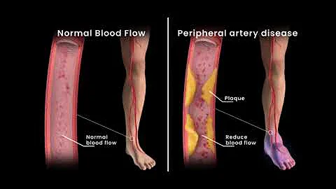 Peripheral Artery Disease Angioplasty