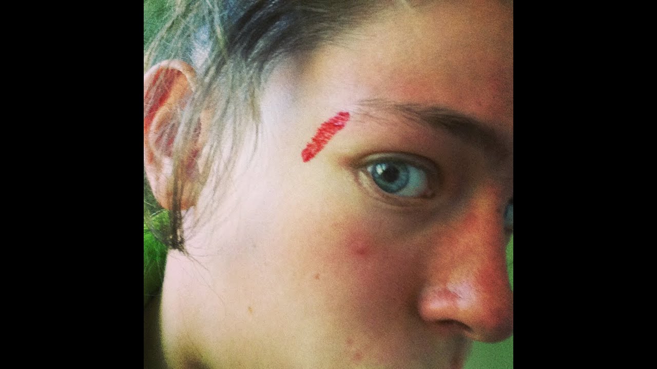 acupuncture gone wrong (9.25.13 day 4) YouTube