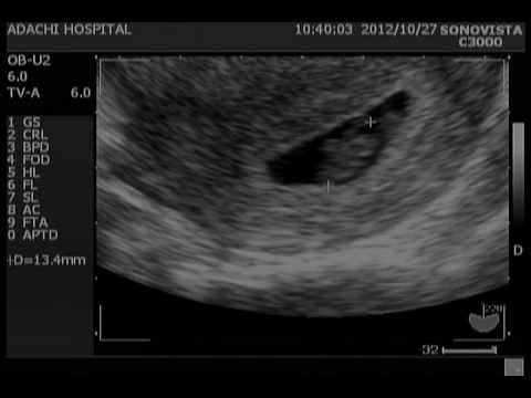 妊娠7週目 7w6d 超音波による胎児の動画 Youtube
