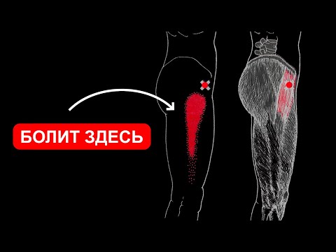 Video: Hyperextended чыканагын кантип айыктыруу керек (сүрөттөр менен)